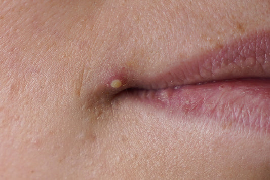 Cómo quitamos este granito en 24 horas