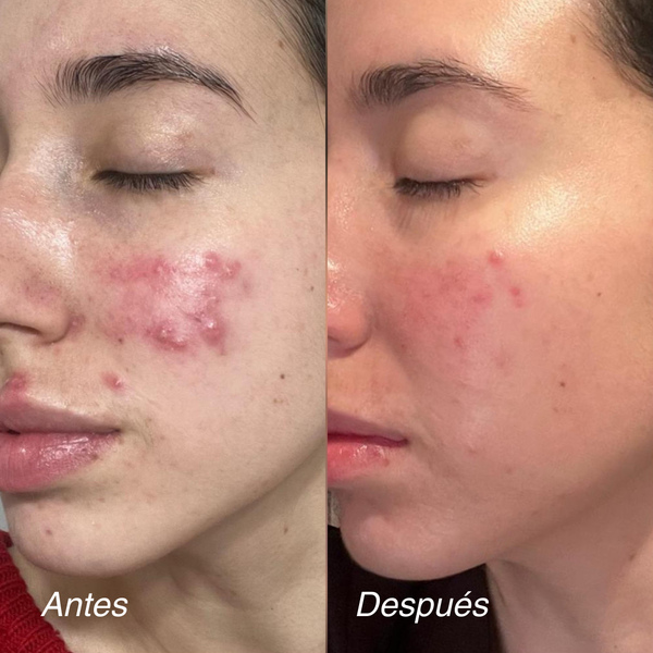 Crema Redness Control